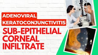 Adenoviral KeratoconjunctivitisSubepithelial Infiltrate [upl. by Asseral]