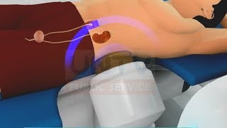 Kidney Stones Actual ESWL procedure [upl. by Andromada]