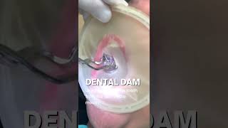 Filling Cavity Dental Dam Isolation  In Office to Hands On Dental Training [upl. by Eveam]