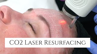 CO2 Laser Facial Rejuvenation  Fix Fine Lines and Wrinkles  Fix Sun Damage  Fix Stretch Marks [upl. by Heidi637]