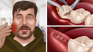 ASMR Animation Wisdom teeth treatment for MrBeast  WOW Brain Dental care [upl. by Donal811]