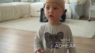 MEDELs ADHEAR Hearing with Microtia and Atresia [upl. by Bethena645]