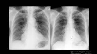 Thorax  Semiologia Radiológica do Tórax  PARTE 1 [upl. by Austen]