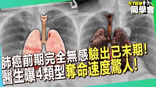 肺癌前期完全無感「咳不停驗出已末期」！醫生曝4類型「惡化快、奪命速度驚人」屬癌症王中王【 57healthy 】陳榮堅 醫師 [upl. by Yrakaz]