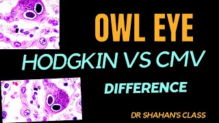 Owl eye Hodgkin Lymphoma vs CMV  How to differentiate fmge neetpg [upl. by Ahsinauj]