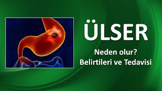 ÜLSER NEDİR NASIL TEDAVİ EDİLİR [upl. by Xila393]