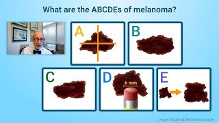 What are the signs and symptoms of melanoma [upl. by Enidaj]