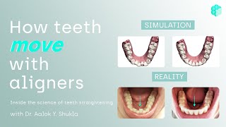 How teeth move with aligners  now explained [upl. by Neela978]