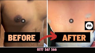 Do you want to see gynecomastia surgery results from 1 centre for gynecomastia treatments [upl. by Ayanet760]