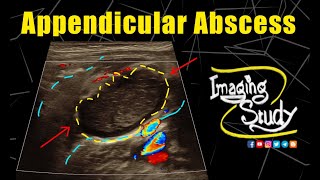 Appendicular Abscess  Ultrasound  Case 332 [upl. by Nidnerb]