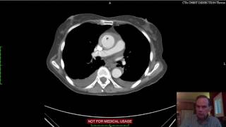 Aortic Mural Hematoma CT [upl. by Blodget261]