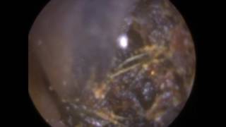 Ear Wax Mass Removed using Esuction  Mr Neel Raithatha The Hear Clinic [upl. by Alban]