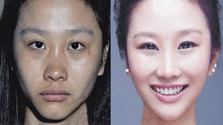 Use Skinlite Cream without side effects to get Fair Skin Hindi [upl. by Elatsyrc]