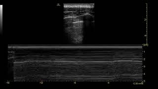 Pneumothorax [upl. by Kramal80]