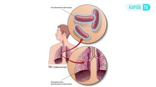 Verem Tüberküloz Nedir Neden Olur [upl. by Yanahc189]