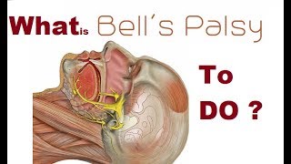 Bells palsy Bengali [upl. by Hubing]