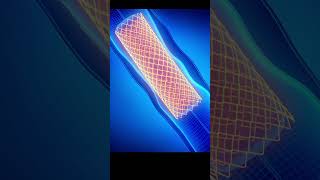 3D Animation of Angioplasty Heart Procedure Medical Animation Explained [upl. by Seaddon468]