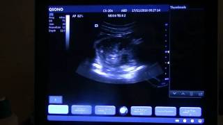 echographe qsono q6 echographie abdominale [upl. by Orgalim119]