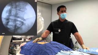 Radiofrequency Ablation Procedure [upl. by Zertnom770]