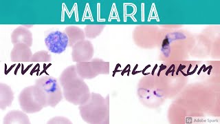 Malaria blood smear Plasmodium falciparum vs vivax headphone ring trophozoite banana gametocyte [upl. by Eibur]