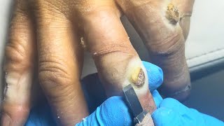 Wow Six huge plantar warts on my hands pedicure pédicure [upl. by Paucker]