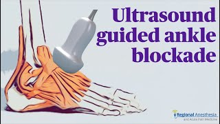 Ultrasound Guided Ankle Block [upl. by Tinor]