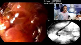 ERCP for severe acute cholangitis [upl. by Airamat]