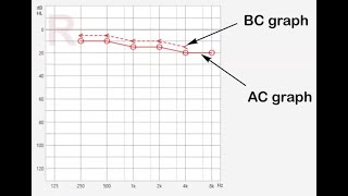 Read and interpret an Audiometry [upl. by Reidar]