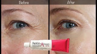 5Year RetinA Update  Before amp After for Wrinkles amp AntiAging [upl. by Goines]