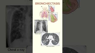 Bronchiectasis  Quick Facts [upl. by Aissat]