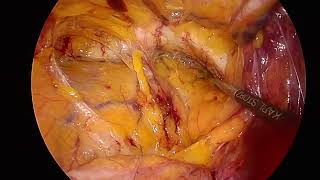 Cirugia de hernia inguinal recurrente por laparoscopia con malla tridimensional [upl. by Thessa815]