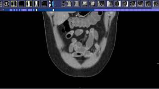 How to read a CT Enterography [upl. by Dazhehs]