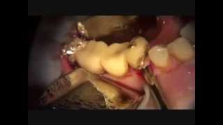 piezosurgery flapless complicated extraction of ankylosed root [upl. by Ungley]