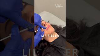 Before amp After Restylane Kysse Lip Filler [upl. by Treb495]