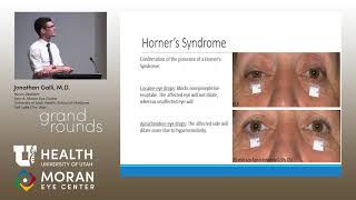 Differential Diagnosis for Painful Horners Syndrome [upl. by Klump809]