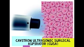 CAVITRON ULTRASONIC SURGICAL ASPIRATOR  CUSA [upl. by Veron]