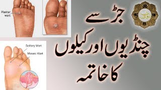 Chandi Ka Ilaaj in urdu  Warts Home Treatment  Gutliyon Se Chutkara [upl. by Chesnut]