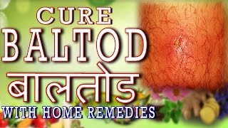 Home Remedy for Baal Tod  बालतोड़With English Subtitle and captions in 162 languages [upl. by Hopper]