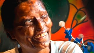 Acid Attack Café Restores Victims Lives [upl. by How555]