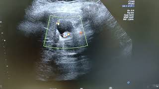 Adenomyomatosis  Comet tail artifacts  Choleithiasis [upl. by Llewop]