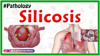 Silicosis Miners phthisis Grinders asthma  Etiology  Pathophysiology  Diagnosis Treatment [upl. by Rodrique]