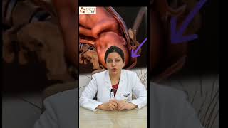 Premature delivery  Dr Rhythm Gupta  IVF Specialist Delhi shorts [upl. by Schroder]