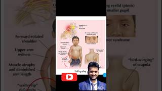 Erbs palsy nerve injury one hand weakness paralysis shorts [upl. by Odla]