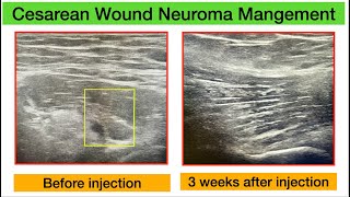 Cesarean Wound Neuroma Clinical Presentation Diagnosis and Successful Treatment [upl. by Neyu]