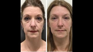 Under Eye Filler Before  After  Nashville Injector [upl. by Orban658]