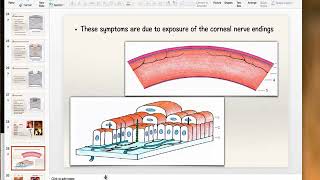 Bacterial Keratitis Part 1 [upl. by Audsley595]