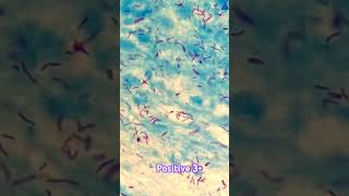 Positive Sputam For AFB Acid Fast Bacilli [upl. by Solraced435]