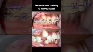 Crooked teeth Braces in 12 months progress braces orthodontics dental dentist teethbits [upl. by Llenal253]