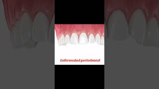 Enfermedad periodontal periodontitis dentista gingivitis parati fyp viral dental enfermedad [upl. by Ahsircal]