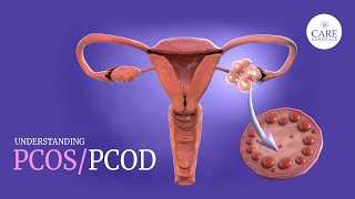 PCOSPCOD Symptoms Causes and Treatment  Menstruation Cycle [upl. by Ocsicnarf]